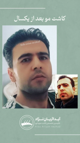 کاشت مو آیدا آریان نژاد