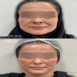 تزریق ژل پلوریال والیوم فیس لیفت3cc