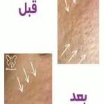 فوتونا فرکشنال اسکار سطح یک