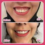 بوتاکس لبخند لثه ای