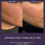 فرکشنال صورت RF
