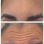 تزریق بوتاکس دیستون صورت