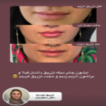 ترمیم ژل با تزریق هیالاز